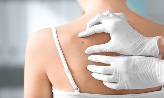 Mateřská znaménka jako skryté nebezpečí 