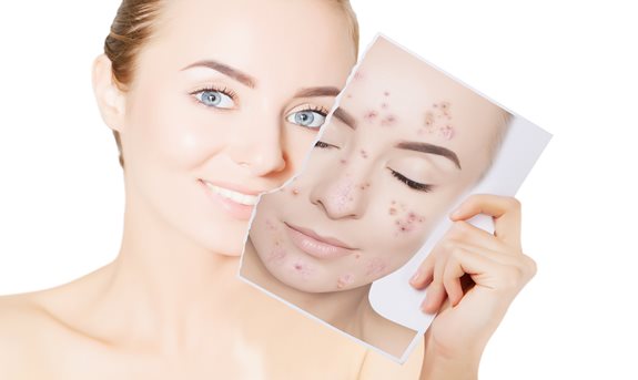 Akné netrápí jen puberťáky