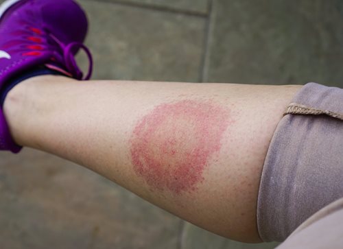 artrita genunchiului medicamente pentru tratament durerea articulară scade la mers